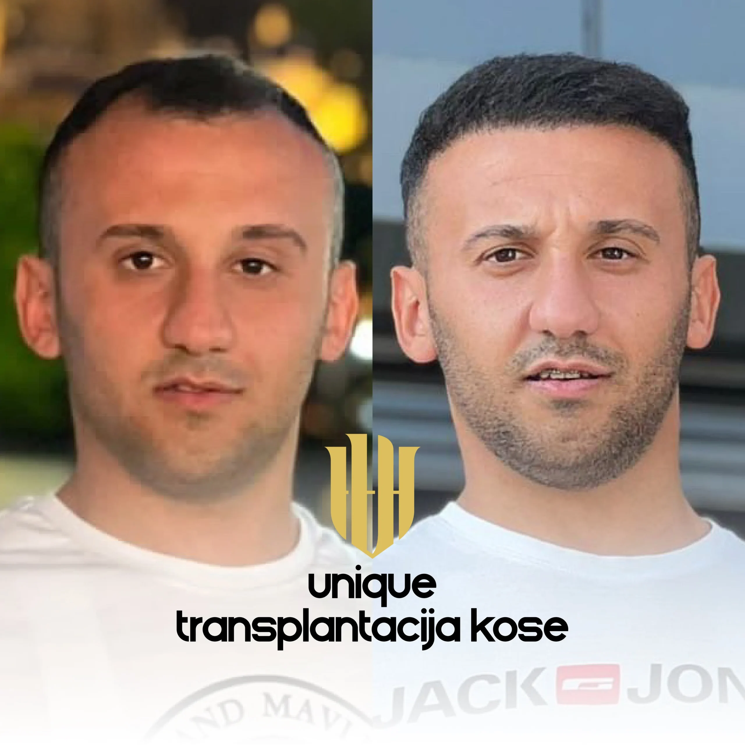Da li je transplantacija kose trajno rješenje?