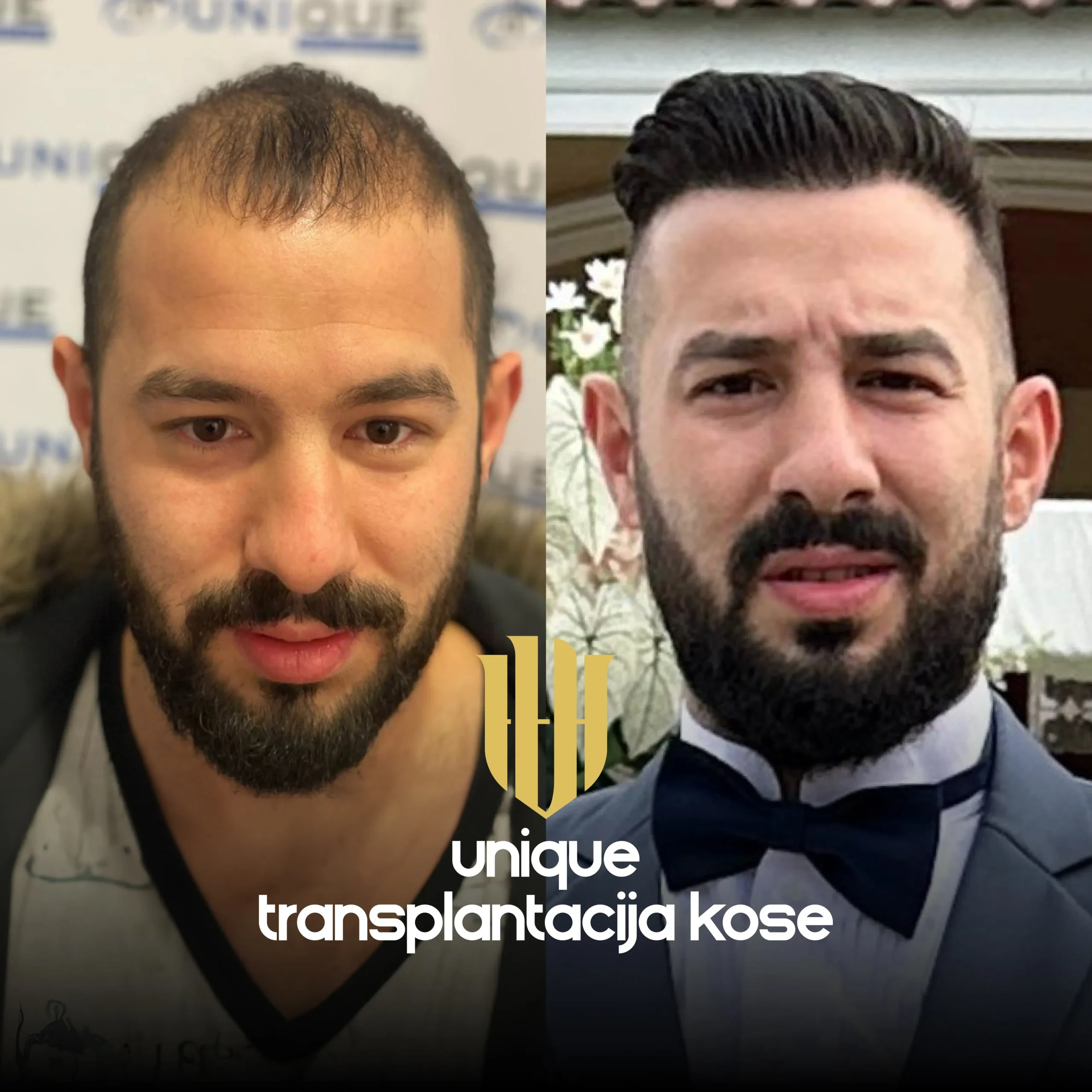 Da li transplantirana kosa izgleda prirodno?