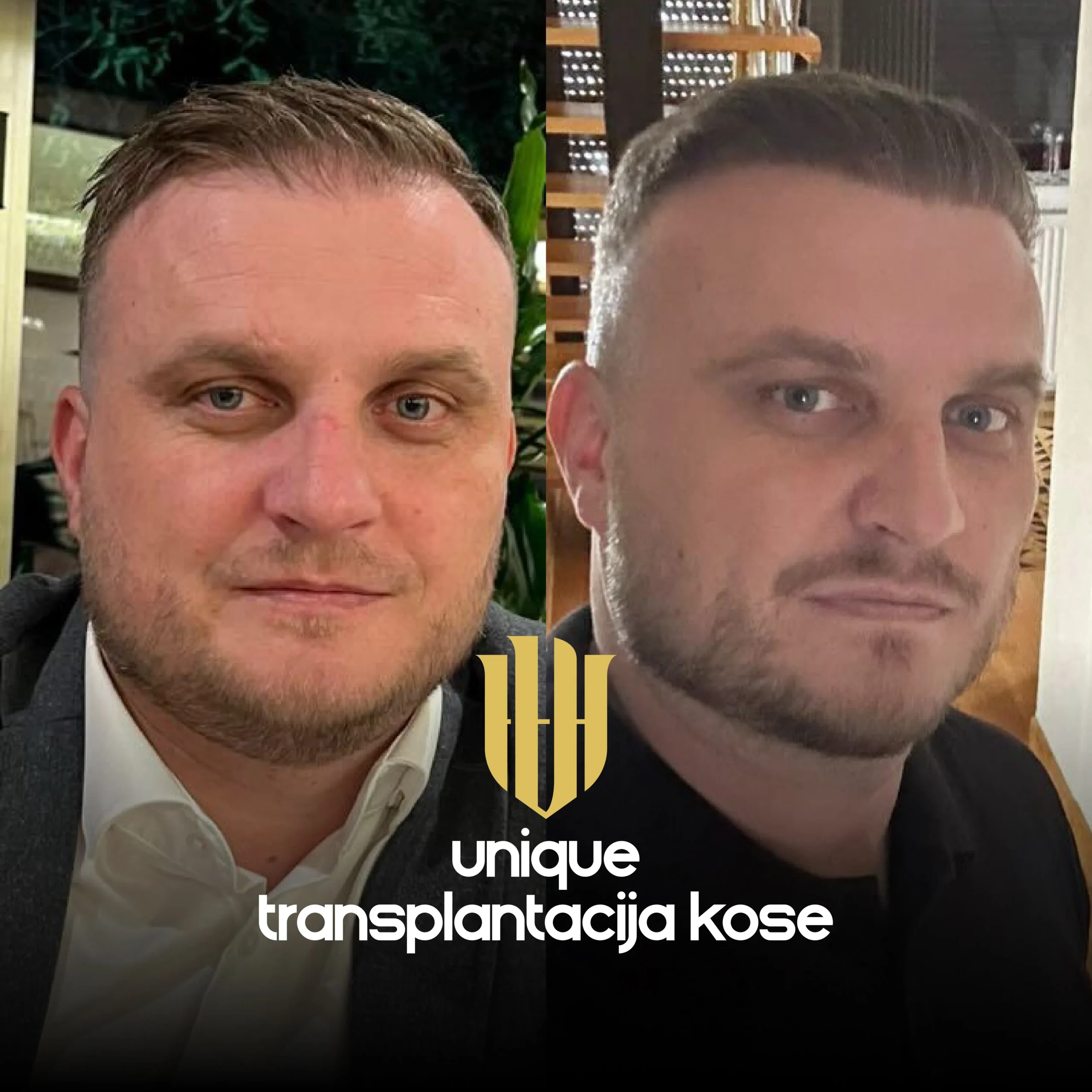 Šta očekivati prvih 7 dana nakon transplantacije kose?