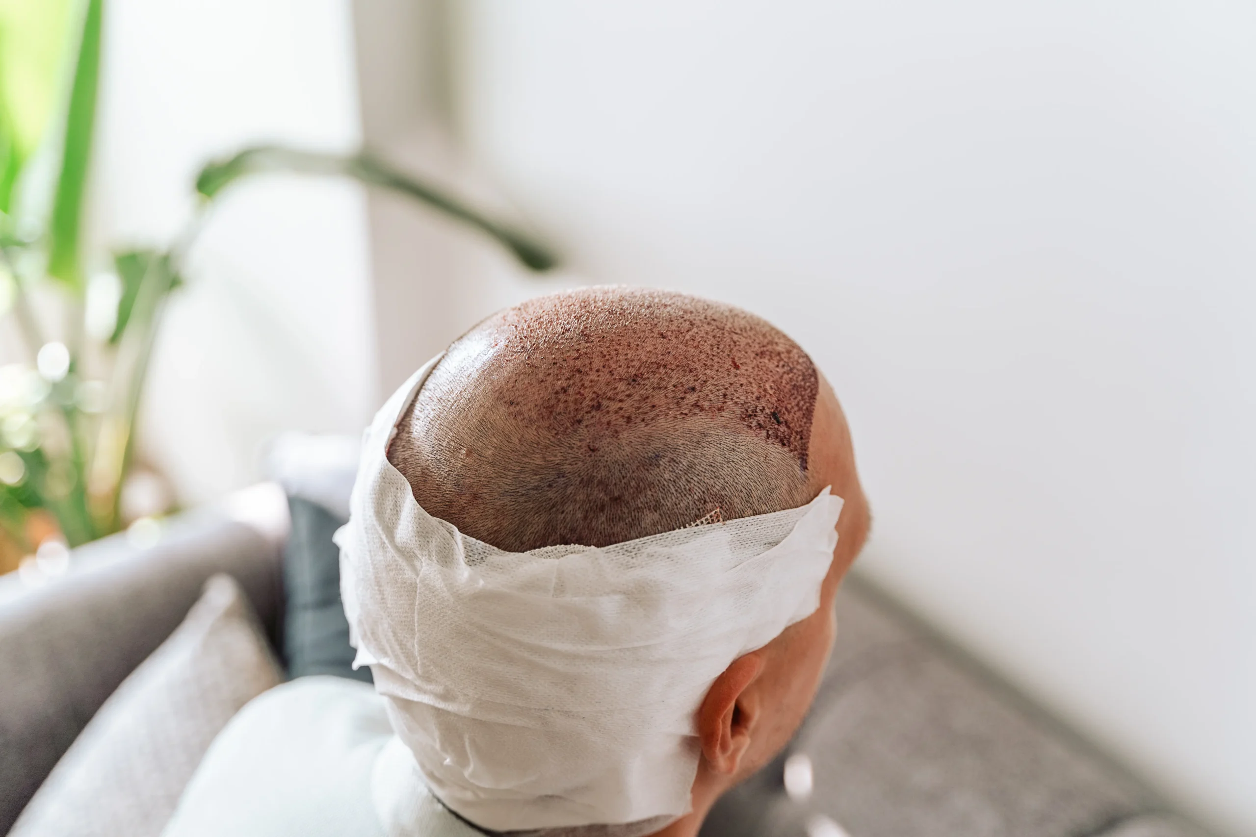 Da li je transplantacija kose bolna i šta možete očekivati?